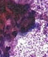 endoscopic view of esophogus