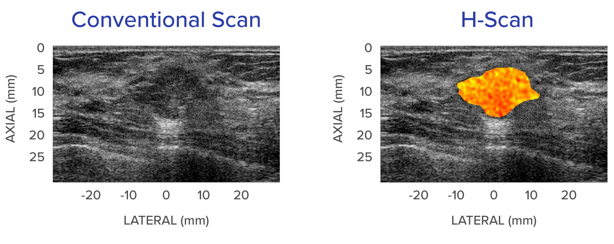 two side by side ultrasound images with one containing an orange mass.