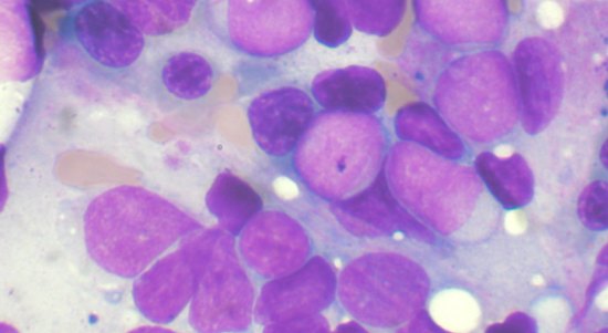 Cancer Cell Metabolism Yields New Insights on Leukemia : News Center