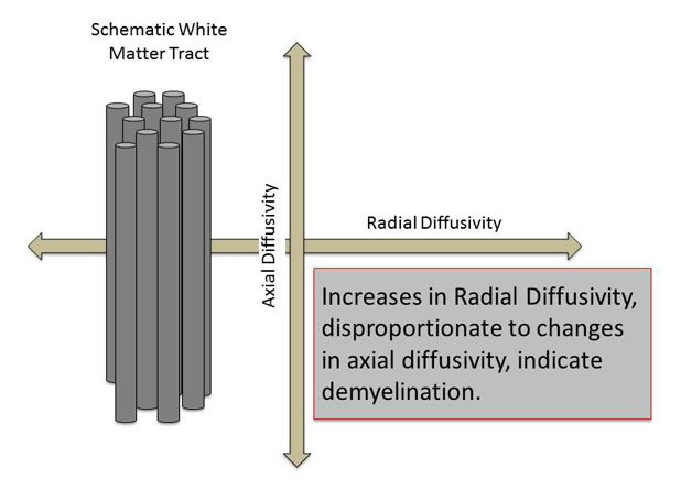 increases in radial diffusity, disproportionate to changes in axial diffusity, indicate demyelination