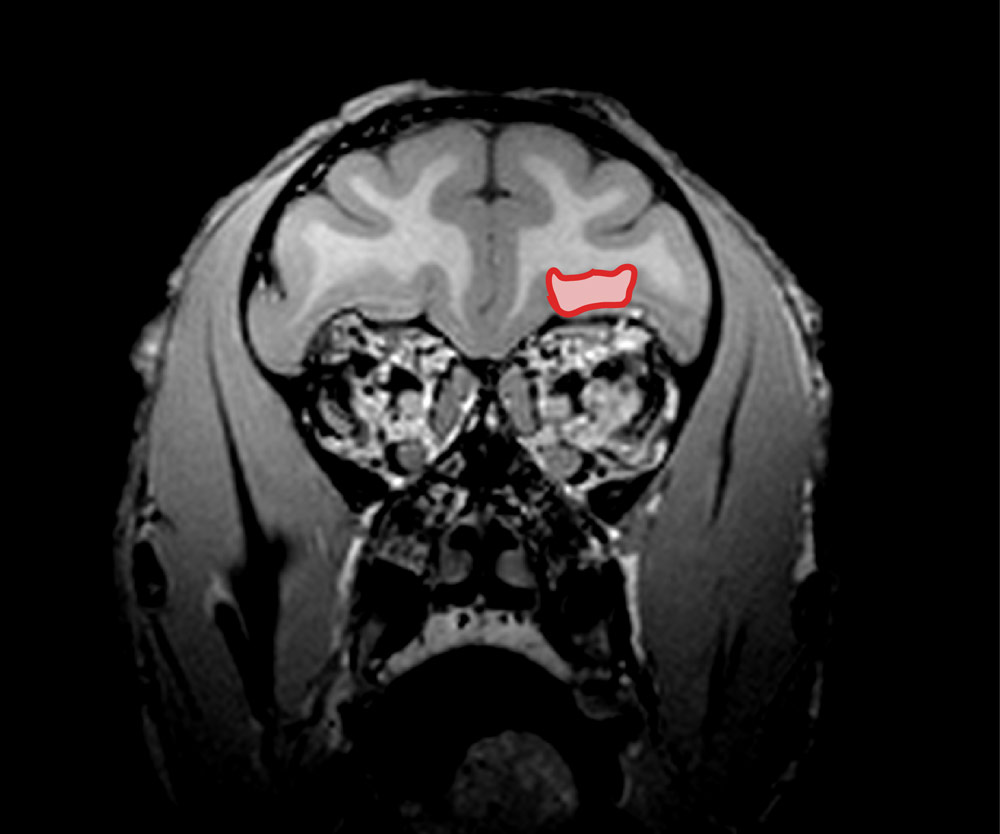 MRI of brain with Orbitofrontal cortex highlighted. 