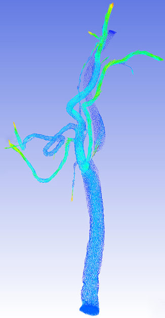 A computer image of blood flow shows flow as streams of blue and green dots in branchlike pattern.