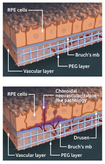 First illustration shows RPE cells, Bruch's mb, PEG layer, and vascular layer; second illustration shows the same but with a choroidal neovascularization-like pathology as well as drusen, or small yellow deposits of fatty protein indicating macular degeneration.